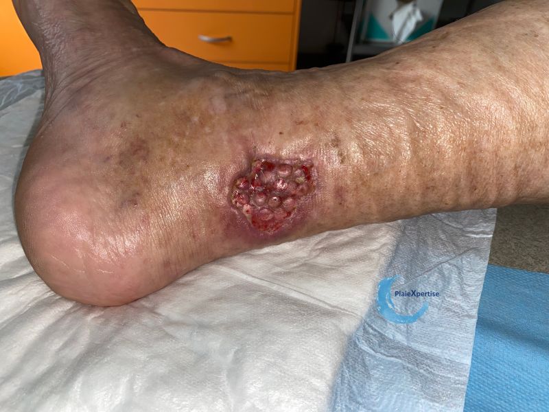 Fichier:Angiodermite typique124.jpg