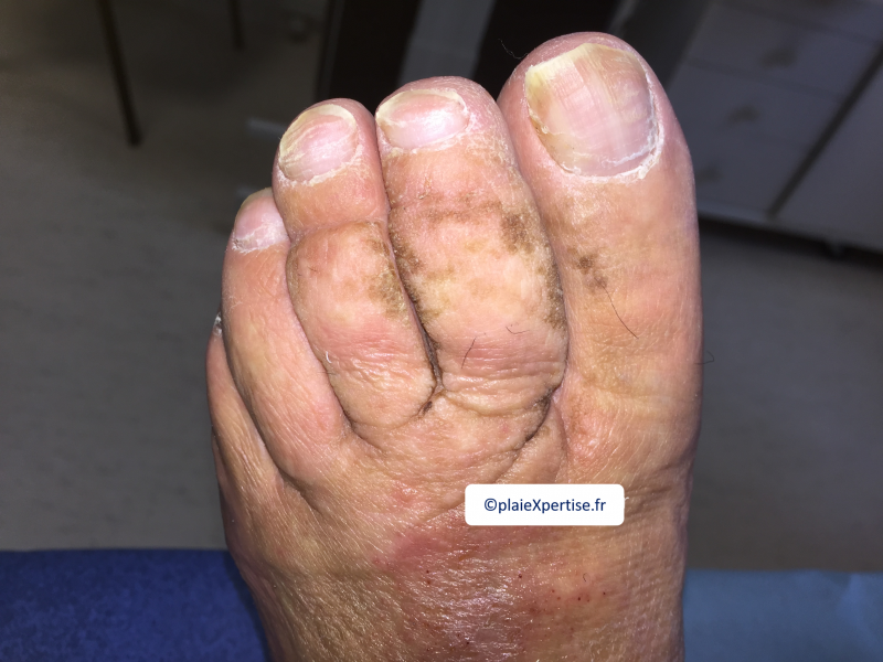 Fichier:Lymphoedème pied13.png