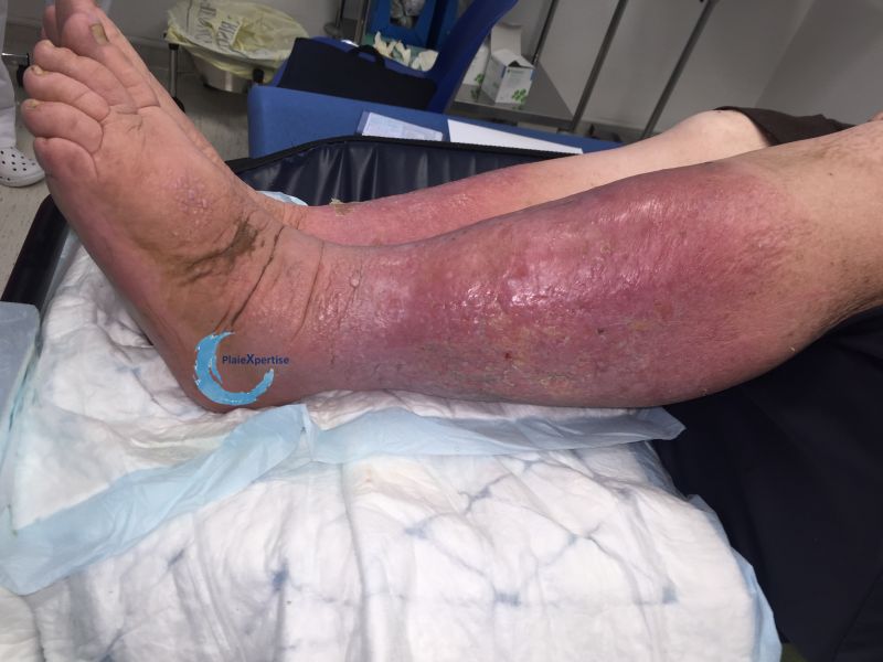 Fichier:Hypodermite chronique50.jpg