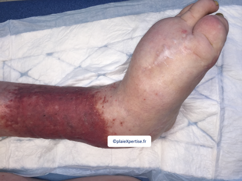 Fichier:Lymphoedème pied5.png