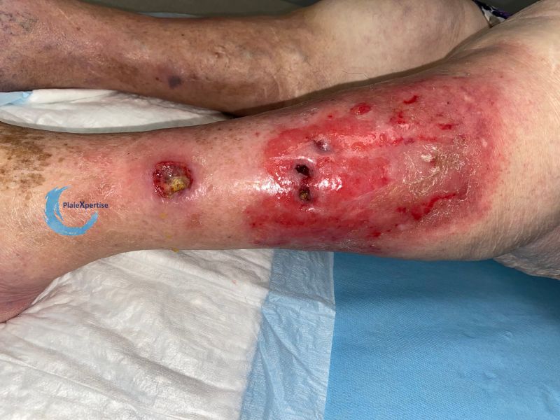 Fichier:Calcifications47.jpg