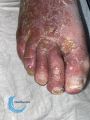 Eczéma119.jpg