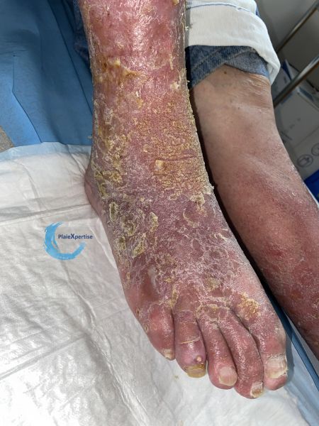 Fichier:Eczéma162.jpg