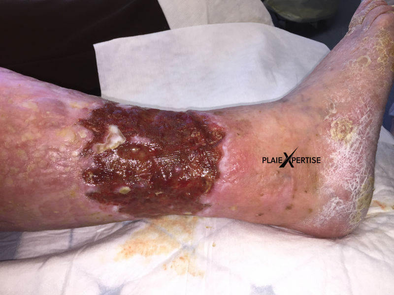 Fichier:Tissu de granulation inflammatoire16.png