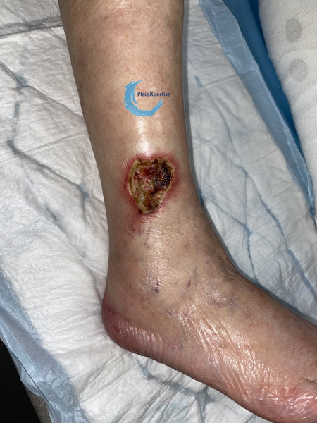 Fichier:Angiodermite typique65.png