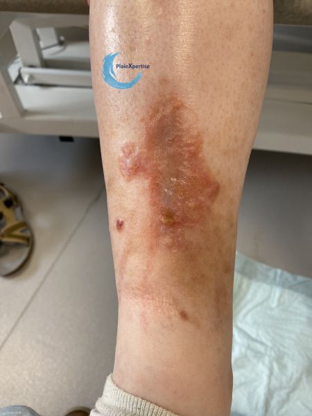 Fichier:Eczéma166.jpg