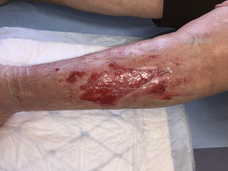 Fichier:Erosion ponctiforme de moins de 5 mm14.png