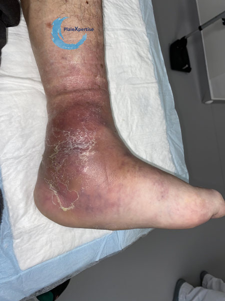 Fichier:Pied de Charcot7.png