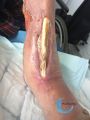 Tendon nécrotique humide61.jpg