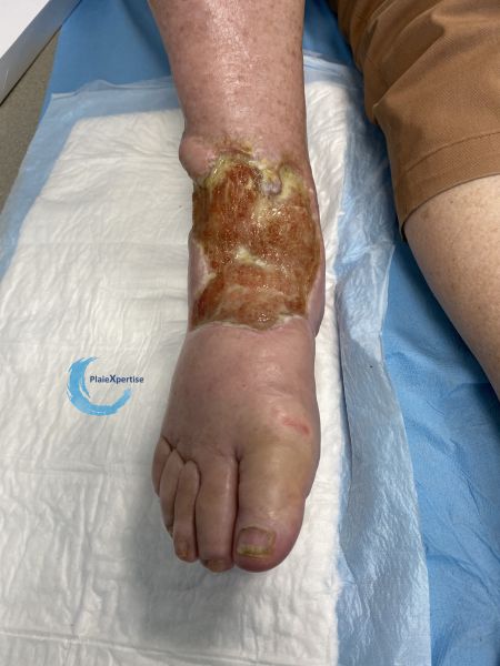 Fichier:Cou de pied83.jpg
