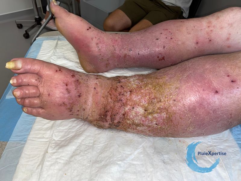 Fichier:Lymphoedème58.jpg