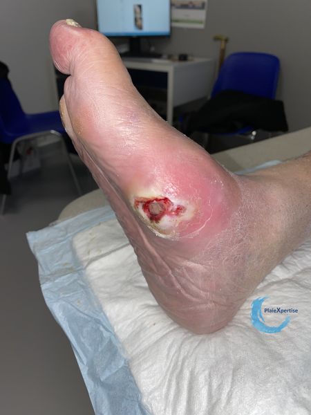 Fichier:Pied de Charcot45.jpg