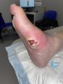 Pied de Charcot45.jpg