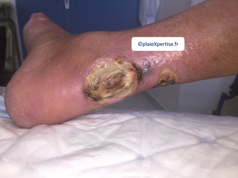 Fichier:Tendon nécrotique humide40.png
