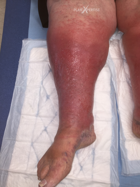 Fichier:Grosses jambes suintantes18.png
