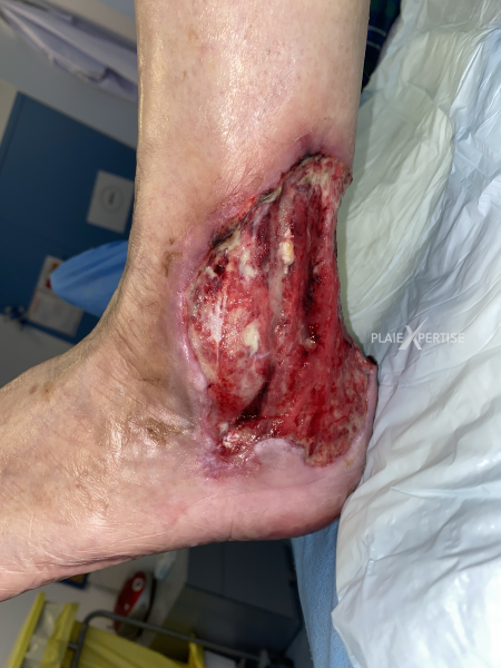 Fichier:Tendon-Reliquat16.png