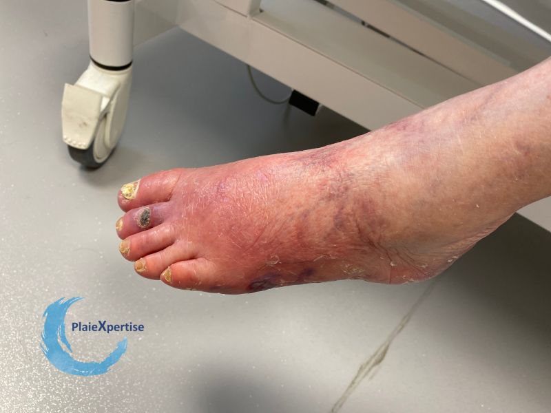 Fichier:Erythrocyanose14.jpg