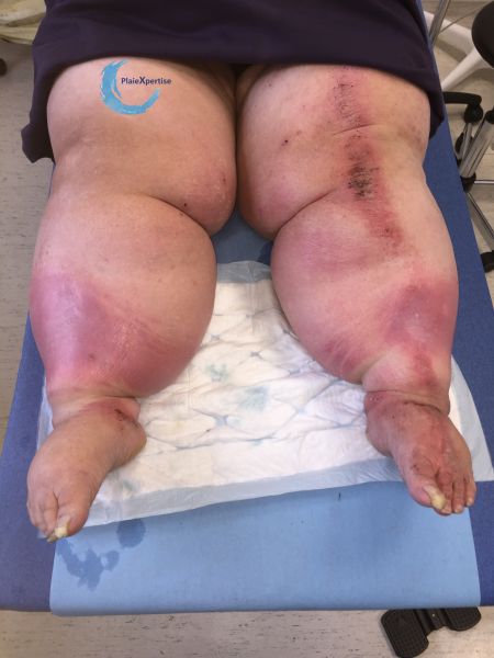 Fichier:Grosses jambes suintantes35.jpg