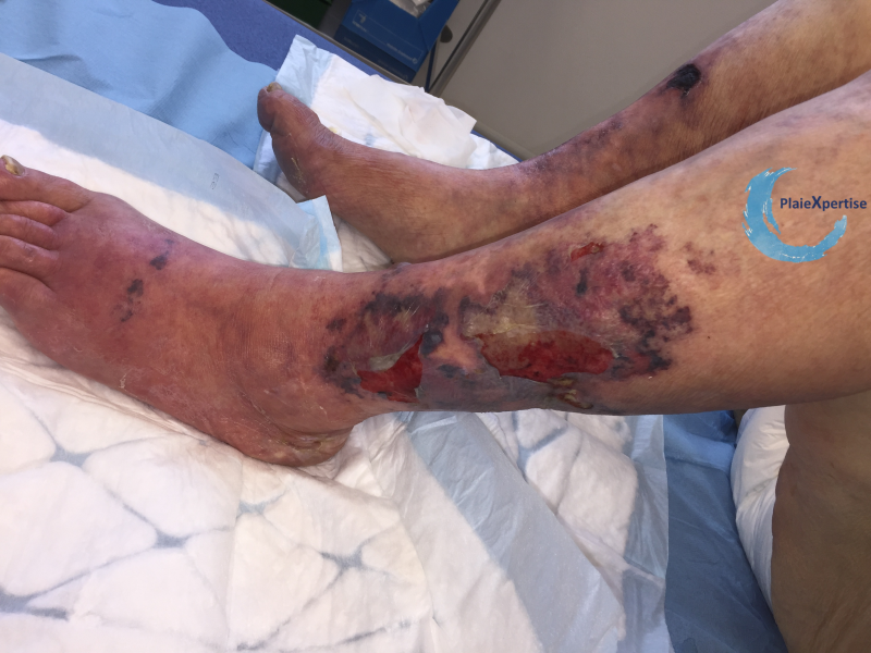 Fichier:Calciphylaxie3.png