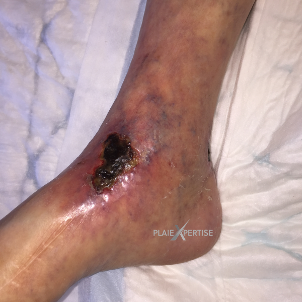 Fichier:Cou de pied44.png