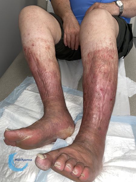 Fichier:Eczéma137.jpg