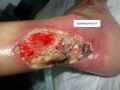 Tendon nécrotique humide7.png