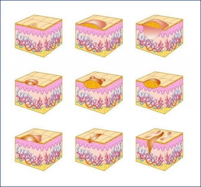 Fichier:Lésions élémentaires de la peau.jpg