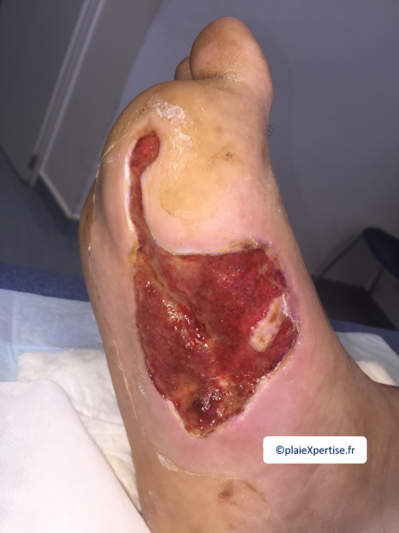 Fichier:Tissu de granulation inflammatoire5.png