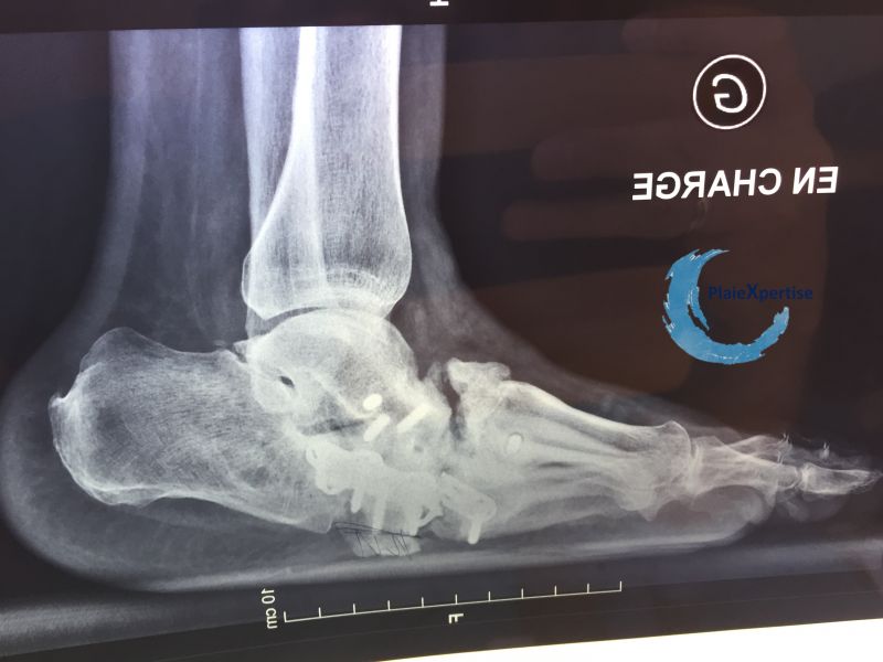 Fichier:Pied de Charcot31.jpg