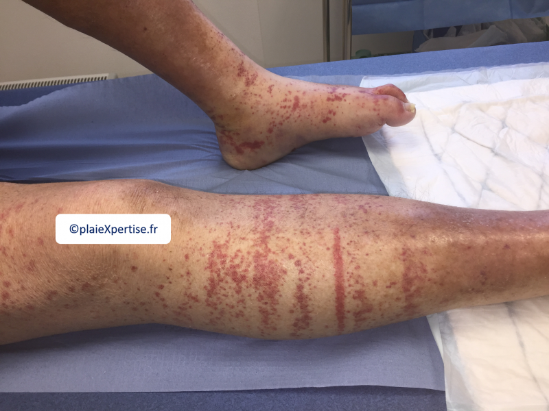 Fichier:Purpura par fragilité capillaire4.png
