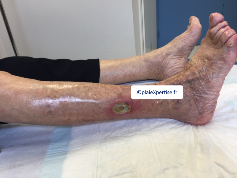 Fichier:Tendon nécrotique humide33.png
