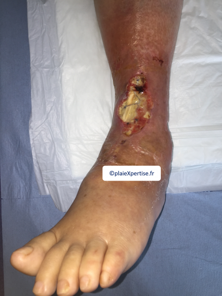 Fichier:Tendon nécrotique humide36.png