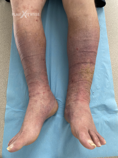 Fichier:Dermiteocre50.png