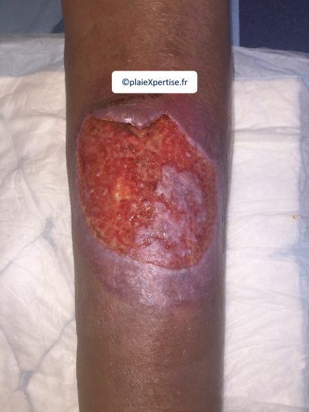 Fichier:Epidermisation1.png