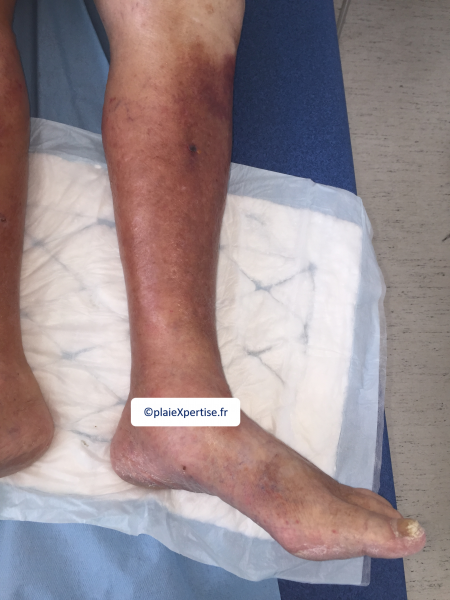 Fichier:Dermiteocre20.png