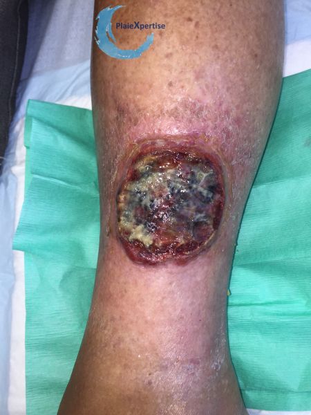 Fichier:Pyoderma gangrenosum31.jpg