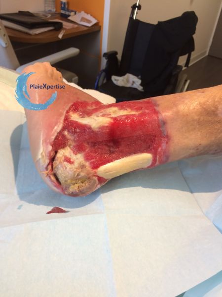 Fichier:Tendon normal33.jpg