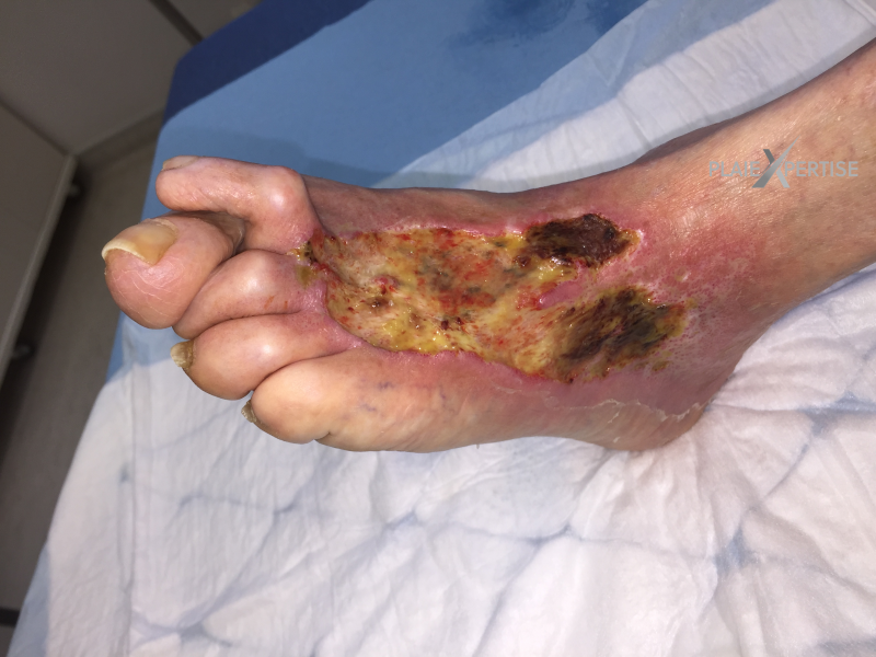 Fichier:Cou de pied30.png