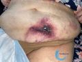 Calciphylaxie7.jpg