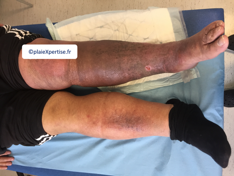 Fichier:Hypodermite chronique8.png