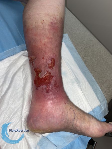 Fichier:Ulcère veineux37.jpg