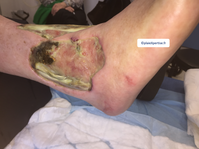 Fichier:Tendon nécrotique humide45.png