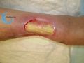 Tendon normal39.jpg
