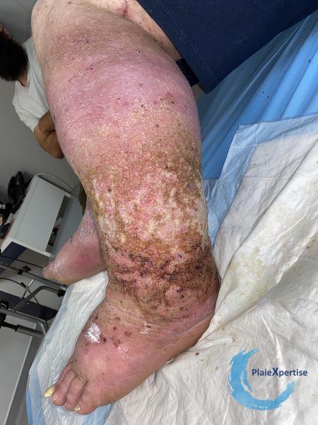 Fichier:Grosses jambes suintantes51.jpg