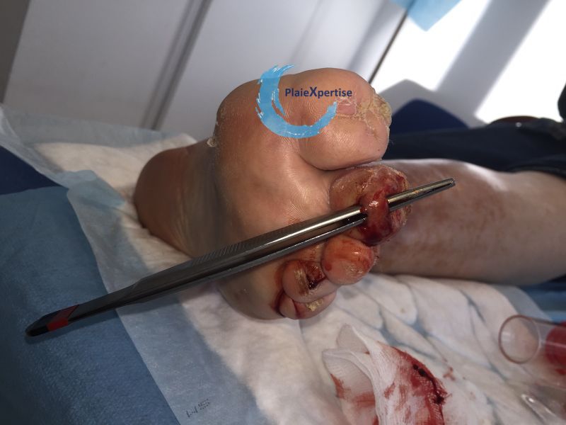 Fichier:Plaies transfixiantes12.jpg