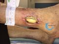 Tendon normal32.jpg