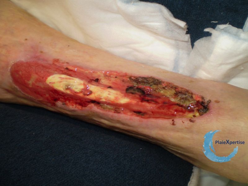Fichier:Tendon normal37.jpg